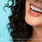 veneers