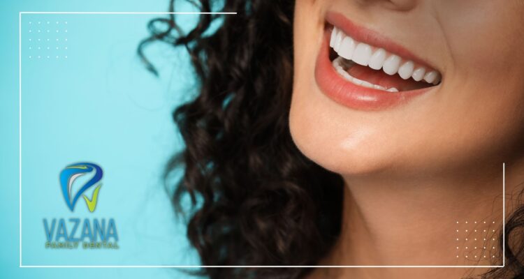 veneers