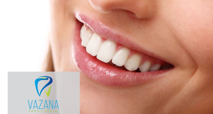 teeth whitening