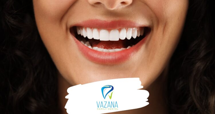 dental veneers