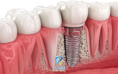Dental Implants in Plantation