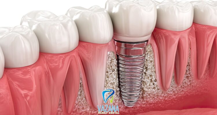 Dental Implants in Plantation